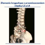 Złamania i Przemieszczenia Kręgów Lędźwiowych: Diagnoza i Leczenie